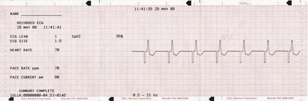 Nauhan yläreunaan tulostuva päivämäärän ja kellonajan merkintä viittaa 6 sekunnin ajalta ennen tapahtumaa oleviin EKG-tietoihin. Kuva 10-4.
