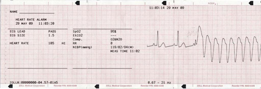Yhteenvetoraportti Sykehälytys käytössä -muoto Yhteenvetoraporttiin tulostuu 6 sekuntia hälytystä edeltäviä potilaan EKG-tietoja.