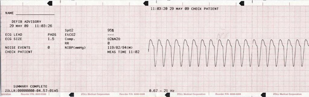 Nauhan yläreunaan tulostuva päivämäärän ja kellonajan merkintä viittaa 6 sekunnin ajalta ennen tapahtumaa oleviin EKG-tietoihin.