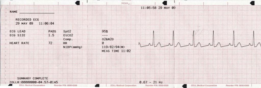 LUKU 10 TAPAHTUMAYHTEENVEDOT JA RAPORTIT Tulostin käynnissä -muoto Yhteenvetoraporttiin tulostuu 6 sekuntia tulostimen käynnistystä edeltäviä potilaan EKG-tietoja.