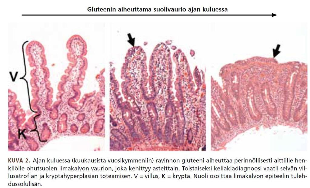 Allergia Aiheuttaja: pääasiassa eläintai kasviperäiset proteiinit Hoito: