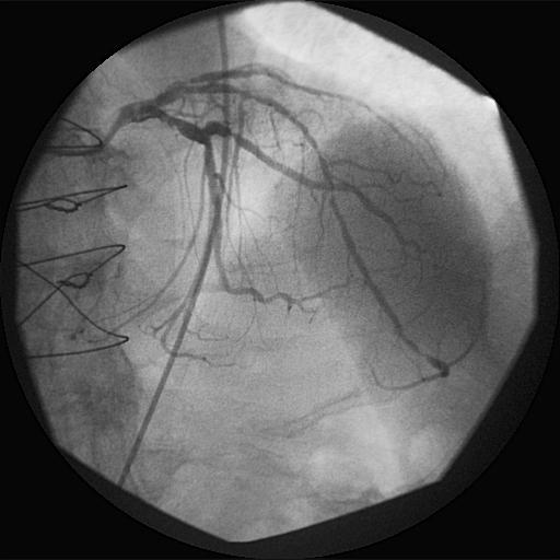 Cardiac allograft vasculopathy Hiljainen progressio, Harvoin rintakipua Muista ACS on mahdollinen sydänsiirtopotilaallakin!