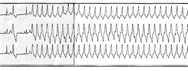 EKG:n pitkäaikaisrekisteröinnin arviointi syketasot (myös suhteessa aktiviteettiin) eteisvärinän vauhtikontrolli johtumisen häiriöt lisälyönnit,