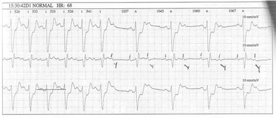 oire ja samanaikainen normaali EKG hyvä ja yleinen havainto Lopuksi: kaikissa rasitus/verenkiertotutkimuksissa tulkinta voimakkaasti riippuvainen