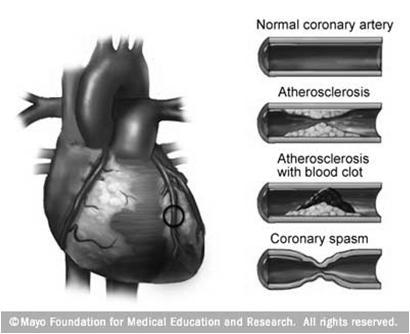 Sepelvaltimotauti ja sydänlihasiskemia Sydänlihasiskemian esille saaminen laboratorio-olosuhteissa Sydänlihaksen hapentarpeen tärkeimmät osatekijät: - vasemman kammion systolinen seinämäkuormitus -