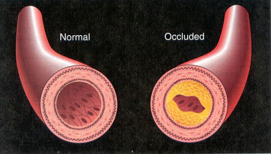 Perfusion of heart decreases by arterial