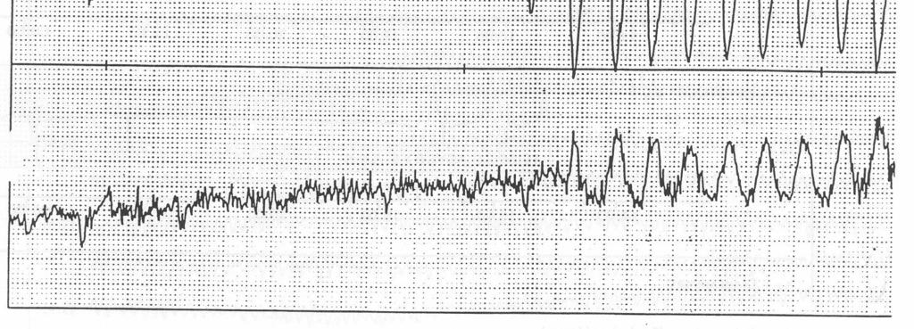 of stroke volume (SV) b) Heart rate and rythm