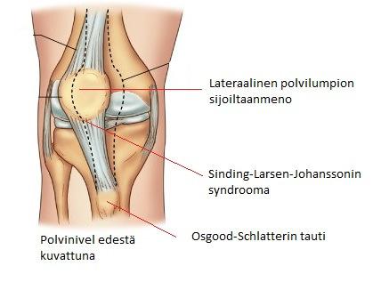 Rasitusvammat Kasvuikäisillä rasitusvammat (kuva 3) johtuvat usein heikosta lihasvoimasta. Lihasvoiman puute vaikuttaa koko alaraajan kineettisen ketjun toimintaan, joka lisää linjaushäiriön riskiä.