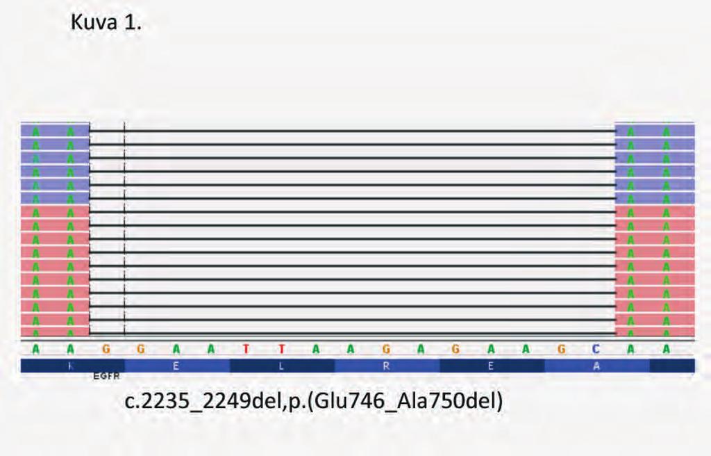 Kuva 1. Esimerkki EGFRgeenin eksonin 19 deleetiosta uuden sukupolven sekvensoinnilla (NGS).