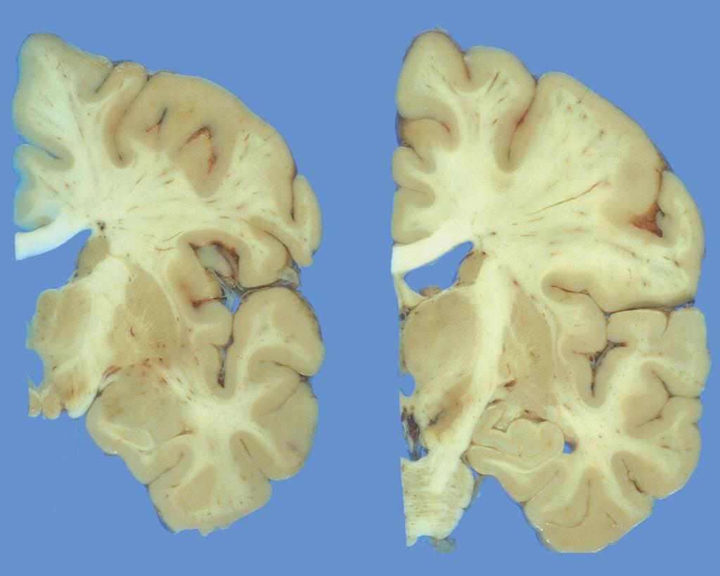 PREFRONTAL-SUBCORTICAL