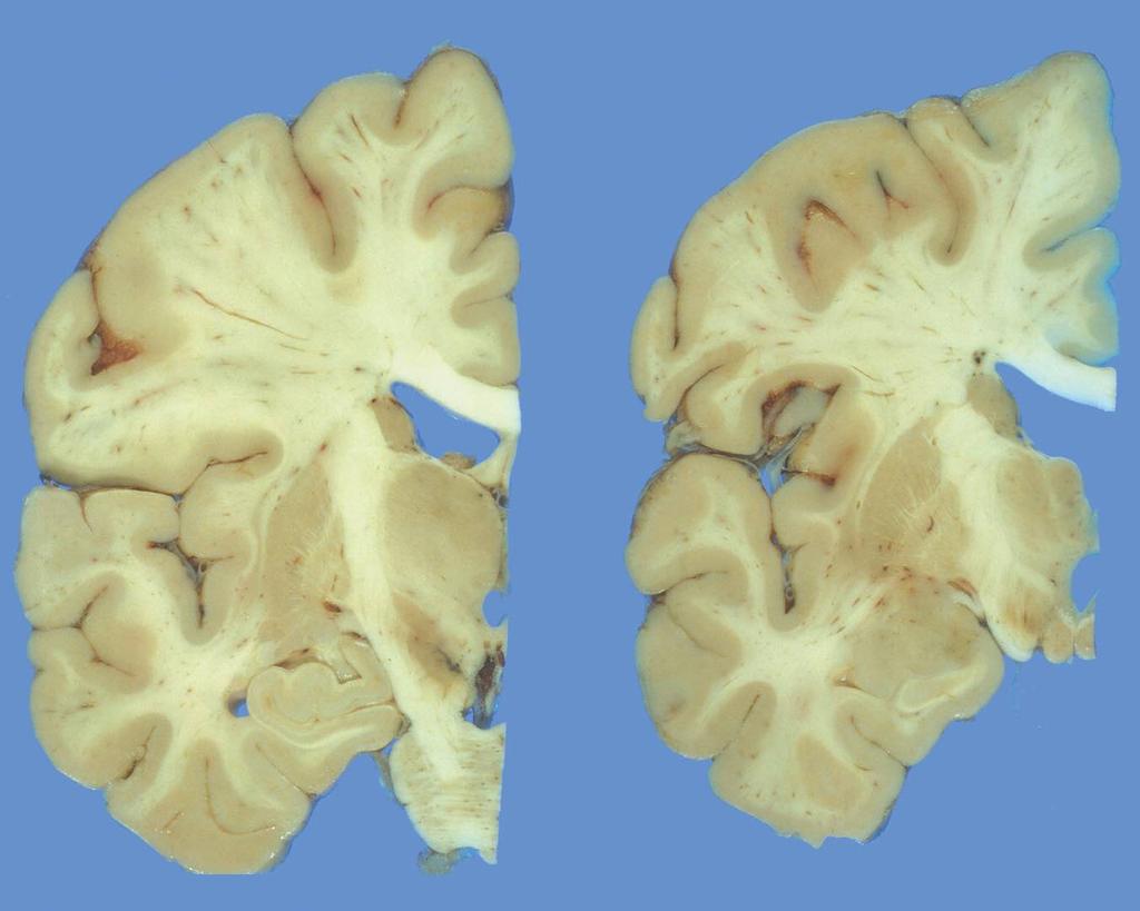 Nucleus caudatus A Globus