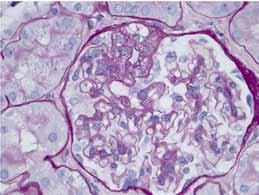 Fokaalinen segmentaalinen glomeruloskleroosi * Kuva 2. Fokaalinen segmentaalinen glomerulo skleroosi.