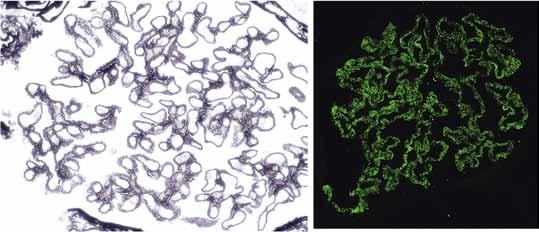 Kuva 4. Membranoosi glomerulonefriitti. Glomerulustyvikalvoilla todetaan immunofluoresenssitutkimuksessa IgG:tä granulaarisina kertyminä (oikea).