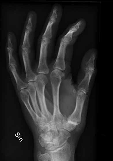 Peukalon kämmennivelen (CMC I nivel) nivelrikossa kirurgisen toimenpiteen valintaan vaikuttavat potilaan ikä, käden käyttöön liittyvät toiminnalliset tarpeet ja nivelrikon laajuus ison monikulmaluun