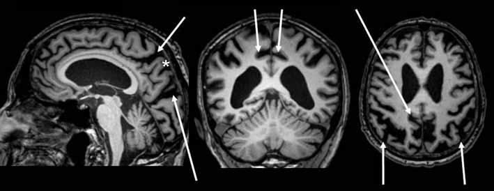 KATSAUS * = Praecuneus Posteriorinen sulcus cinguli Fissura parieto-occipitalis Parietaalilohkot Kuva.