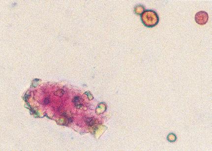 d) Välimuotoisen epiteelin soluja ja granulosyyttejä infektoituneessa virtsanäytteessä; bakteerit eivät