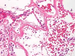 A B KUVA 1. DAD obduktionäytteissä. A) Akuutin eksudatiivisen vaiheen tyypillinen histologinen piirre on soluttomien hyaliinimembraanien esiintyminen.