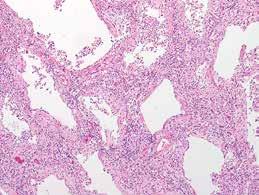 Alveolitiloihin ja alveoli seinämiin syntyy tuoretta sidekudosta. eteneviä tehohoitoa vaativia sairauksia, jotka voivat johtaa kuolemaan. DAD:n histologia.