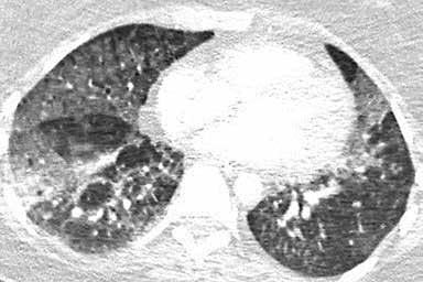 COP on tyypillisesti läiskäinen ja ympäröivän keuhkokudoksen rakenne on normaali (23). OP:n radiologinen diagnostiikka.