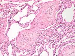 KUVA 3. OP:n histologiassa alveoleissa on tarkkarajaisia tuoreita sidekudoskertymiä, jotka voivat työntyä alveolitiloista toiseen. COP:ssa tulehdussolukkoa on tyypillisesti vähän.