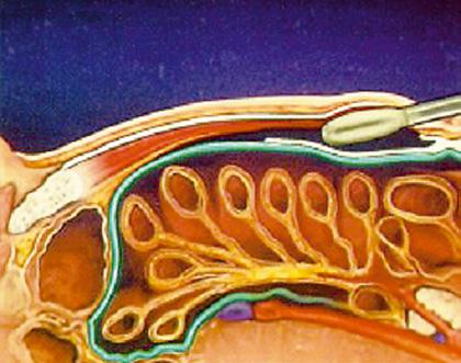 A B C D Kuva 5. Endoskooppinen preperitoneaalinen hernioplastia. A) Tunnelointi suoran vatsalihaksen tupen tekokohdan etupinnalta alkaen. B) Laajentimen käyttö tunneloinnin apuna.