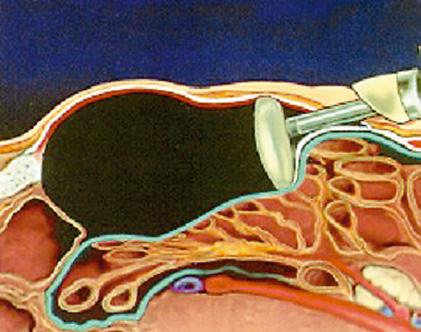 Vähintään 10 x 15 cm:n kokoinen suora verkko voi olla osittain imeytyvä tai anatomisesti muotoiltu.