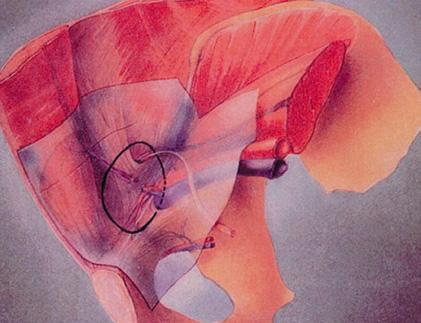 Anatomisesti muotoiltua verkkoa ei yleensä tarvitse kiinnittää. Kaasun poistamisen yhteydessä varmistetaan, että verkko pysyy paikallaan eikä vatsakalvo jää sen taakse.
