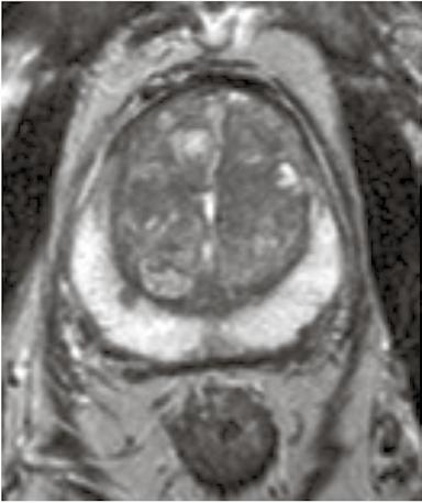 Hermo-verisuonikimput kulkevat tavallisesti eturauhasen vieressä posterolateraalisesti molemmin puolin ja ovat erotettavissa rasvan keskellä niukkasignaalisina nauhamaisina rakenteina (siniset