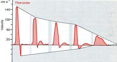 yli kammion paineen (kuva 22-2) Syynä veren inertia ja siihen liittyvä kineettisen energian komponentti Aorttaläppä kiinni