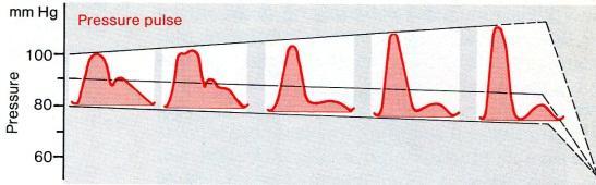 Aorttastenoosi; aalto matala ja leveä (alentunut virtaus) Tunnustellessa pitkä