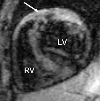 A B KUVA 1. Sydänsarkoidoosipotilaan sydämen T2-rasvasuppressiokuvissa näkyy poikkileikesuunnassa kammioväliseinän etuosassa kirkasta kudosturvotusta (A).