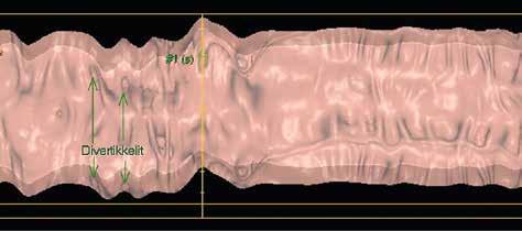 A B KUVA 2. Tyypillinen näkymä kohtalaisesti laajentuneesta sigmasuolesta dissektio- ja 2Dkuvissa. A) Dissektionäkymässä suoli on laskennallisesti avattu ja suoristettu.