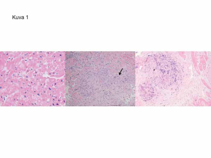 A B C * KUVA 1. Sarkoidoosin ja jättisolumyokardiitin histologiaa. A. Normaalia sydänlihasta (hematoksyliini/eosiinivärjäys). B. Sydänsarkoidoosi.