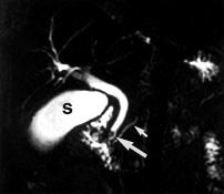 Kuva 1. Sappitiekivi näkyy signaalinpuutoksena ductus choledochuksen distaaliosassa (iso nuoli) paksussa koronaalisuunnan magneettikuvassa. Kivi on aiheuttanut ductus choledochuksen laajentuman.