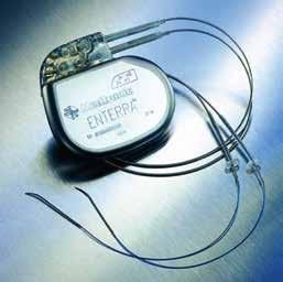 DIABETES Ruokatorvi Kardia Fundus Pylorus Duodenum Mahan runko Antrum 1 cm 10 cm KUVA 4. Neurostimulaattori johtoineen. KUVA 5. Neurostimulaattorin johtojen sijainti antrumissa.