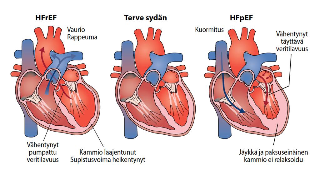 Systolinen ja diastolinen sydämen vajaatoiminta
