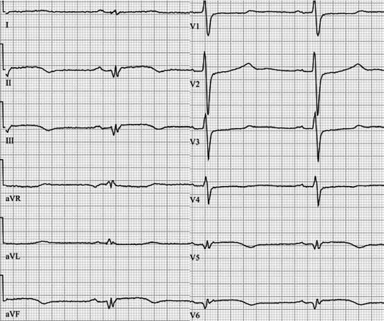 KUVA 3. Seuraavana aamuna otettu 12-kanavainen EKG (50 mm/s).