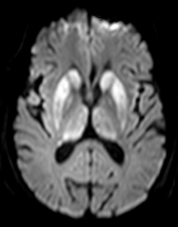 KATSAUS mion laajeneminen ja aivorungon atrofia. Kortikobasaalisessa rappeumassa havaitaan epäsymmetristä kortikaalista atrofiaa ja signaalinmuutoksia tyvitumakealueella.