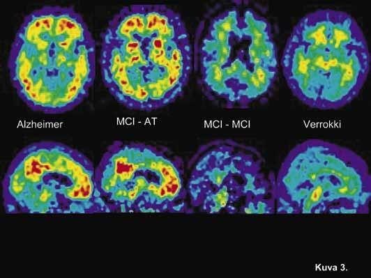 KATSAUS osoitettu Alzheimerin taudissa muun muassa N-asetyyli aspartaatin vähentynyt konsentraatio temporaalilohkon mediaaliosassa ( Jessen ym. 2009).