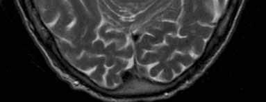 Ohimolohkojen etuosat, varsinkin neokorteksi ja siitä gyrus temporalis inferior ja medius, ovat molemmin puolin atrofioituneet.