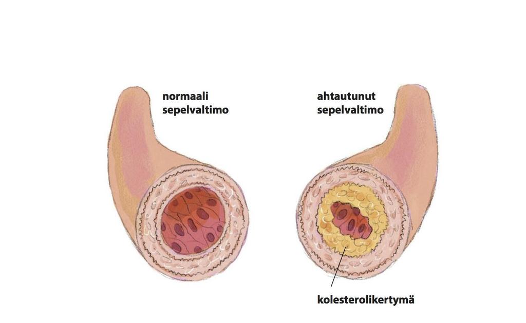 Sepelvaltimoahtautuma, kaavakuva Kirjassa