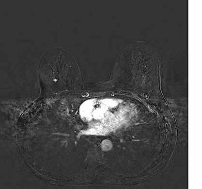 KUVA 1. Oireettoman naisen mammografia- ja kaikukuvauslöydökset olivat normaalit, mutta hän toimi testipotilaana uuden magneettikuvauslaitteen käyttöönoton yhteydessä.