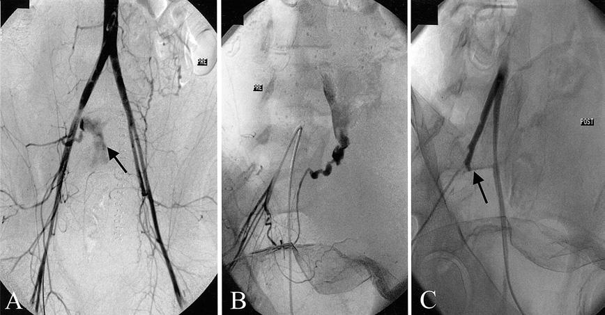 Kuva 2. Keisarileikkauksen jälkeinen atonisena pidetty vuoto potilaalla 3. A) Varjoaineruiskutus aortan alaosaan osoittaa runsaan vuodon (nuoli) oikeasta kohtuvaltimosta.