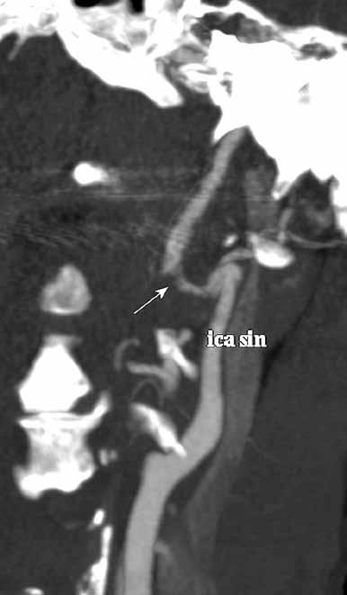 A B KUVA 2. A) TT-angiografiassa havaittiin vasemman sisemmän kaulavaltimon kaventuma. Suonen seinämä on kaventuman kohdalla rosoinen (nuoli), mikä viittaa dissektoitumaan.