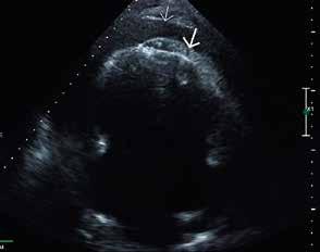 A B KUVA 1. A) Poikkeavan runsas sydänpussineste kaikukuvauksessa (ohut nuoli). Nestekertymän ohella sydänpussi näyttää paksuuntuneelta (paksu nuoli).