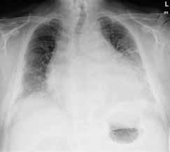 TEEMA: SYDÄNPUSSIN SAIRAUDET KUVA 3. Keuhkokuvassa huomattavasti suurentunut sydänvarjo syöpää sairastavalla potilaalla, jolla myöhemmin poistettiin lähes kaksi litraa sydänpussinestettä.