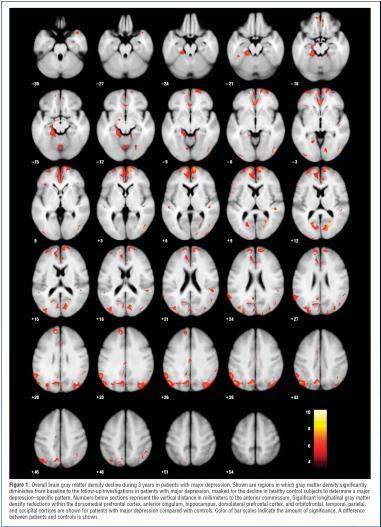 Mitä depressiopotilaan aivoille tapahtuu ajan myötä? Etenevä rakenteellinen magneettikuvaustutkimus depressiopotilaista.