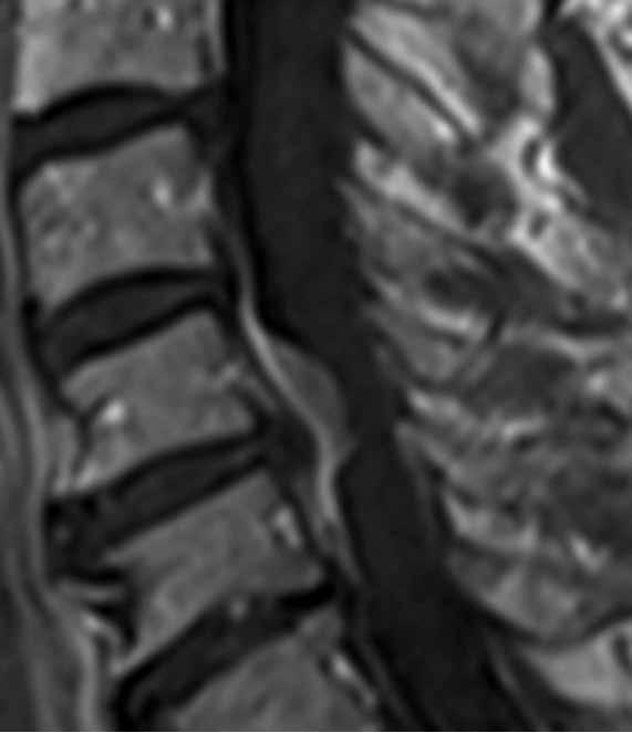 A KUVA 4. A) Magneettikuvassa selkäydintä edestä päin painava meningeooma CV- ja CVI-nikamien kohdalla 75-vuotiaan miehen kaularangassa.