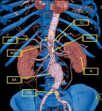 Kuva 1. Tietokonetomografian pintarekonstruktion etukuva vatsa-aortasta. Kuvassa näkyvät suonten anatomiset rakenteet, patologiset tilat ja kollateraalikierto.