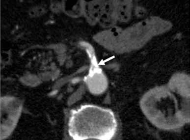 A B Kuva 3. Tietokonetomografia arteria mesenterica superiorin alkuosan tasolta. Ruokailunjälkeisen kivun ja laihtumisen syyksi epäiltiin mesenteriaalisuonten ahtautumista.